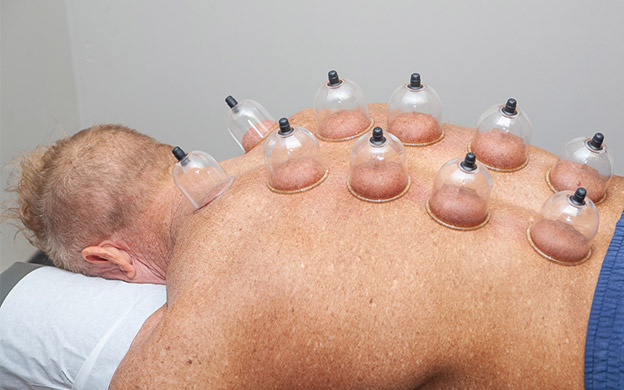 cupping